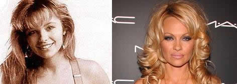 Chirurgia delle celebrit: Pamela Anderson e la chirurgia estetica