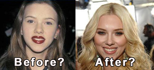 Chirurgia delle celebrit: Scarlett Johansson