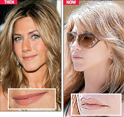 Chirurgia delle celebrità: Jennifer Aniston