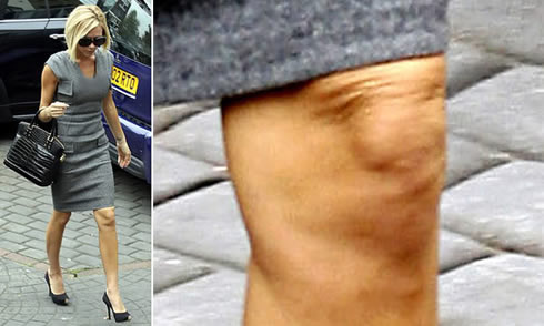 Celebrit cellulite: Victoria Beckham e la cellulite