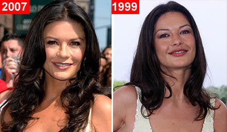 Chirurgia estetica da star: Catherine Zeta-Jones